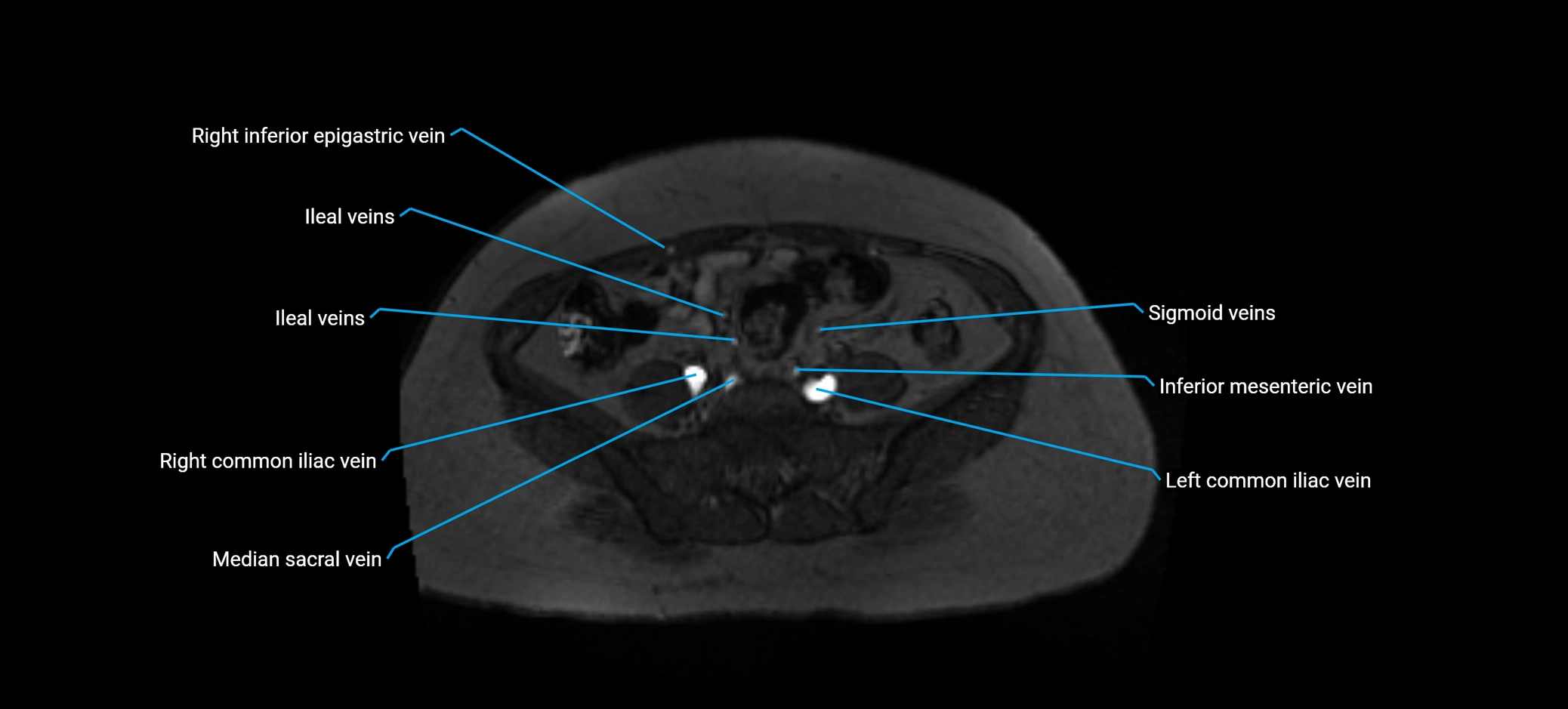 MRV abdomen pelvis & lower limb axial cross sectional anatomy labelled MRI image 130 (1).webp
